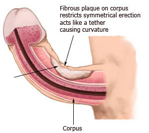 Curvature Of The Penis 67