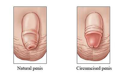 Circumcision